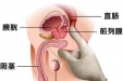 慢性前列腺炎