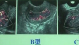 反复胚胎移植失败系列之四：子宫动脉血流
