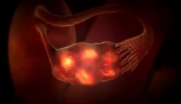 反复胚胎移植失败系列之六：致高龄不孕女性