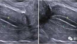 A型子宫内膜、内膜三线征与胚胎着床
