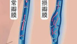 【男泌书】精索静脉曲张还能运动吗？