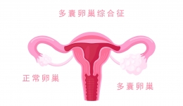 【PCOS大揭秘】30个知识点，助你全面了解“多囊”世界！