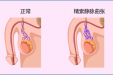 【男泌书】海拔会影响精索静脉曲张？