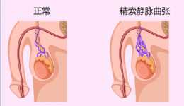 【男泌书】海拔会影响精索静脉曲张？