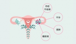 多囊卵巢综合征为何“青睐”这一女性群体？她们大多有这些特点