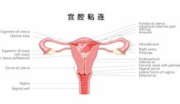 宫腔粘连和不孕：那些你得知道的事儿