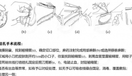 【男泌书】男性的长期避孕手段：输精管结扎手术