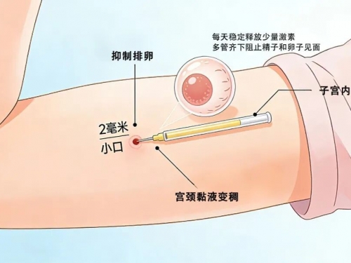 不想戴套也不想吃药？避孕也可以这样做！